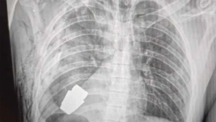 हमले में घायल सैनिक के सीने में मिला जिंदा बम, जारी की X-Ray की तस्वीर