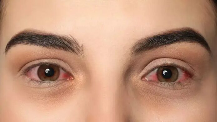 आंखों मेें हो गई है Infection तो इस तरह करें Eye Care